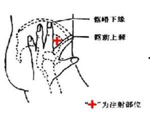 肌肉注射操作视频教程