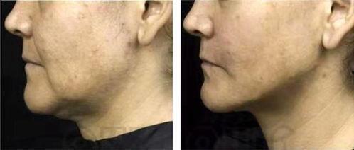 法令纹视频,如何有效预防和改善面部皱纹